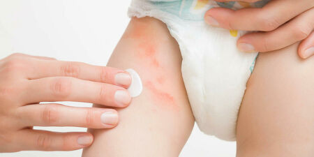 Dermatite atopica: trattamenti cosmetici per ridurre l'uso di farmaci